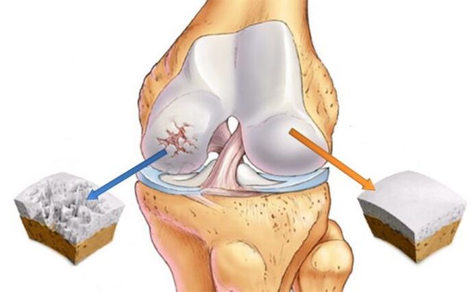 What is osteoarthritis