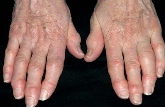 Hand osteoarthritis