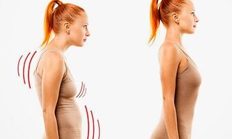 The reasons for the development of cervical osteochondrosis