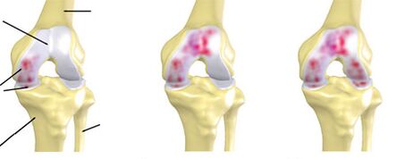 Degree of osteoarthritis