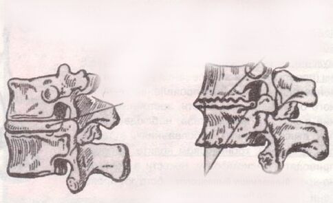 The intervertebral disc is healthy and with lumbar osteochondrosis