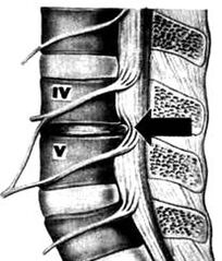 X -Ray image of the department of lumbar osteochondrosis