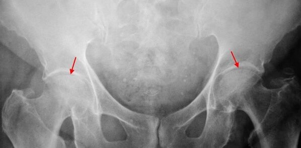 Double coksarrosis co -kkarsis of the articular gap, sclerosis of the articular surfaces