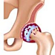 Hip joint osteoarthritis