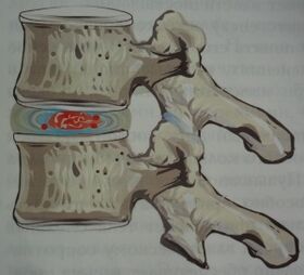 First stage of osteochondrosis.