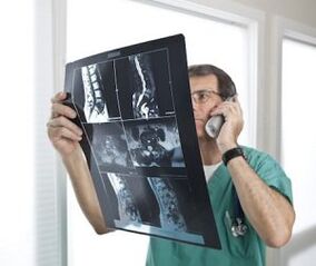 Myelography for the diagnosis of osteochondrosis and intervertebral hernias.
