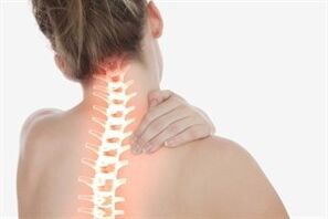Cervical osteochondrosis in a woman.