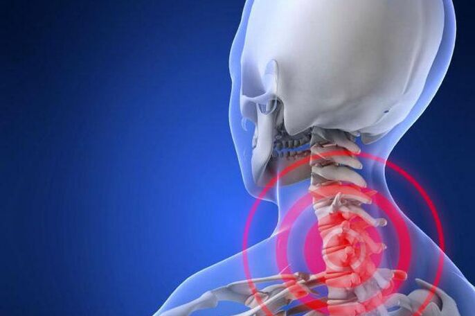 Stabbing pain in the neck is an early symptom of cervical osteochondrosis