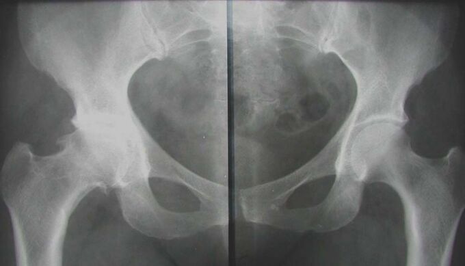 x-ray of hip joint affected with osteoarthritis
